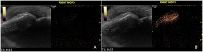 Contrast-enhanced ultrasound as a valuable tool to detect minimal inflammation in RA patients in sustained remission